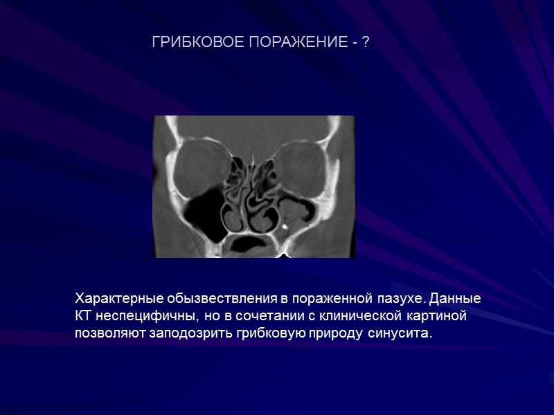 Характерные обызвествления в пораженной пазухе. Данные КТ неспецифичны, но в сочетании с клинической картиной